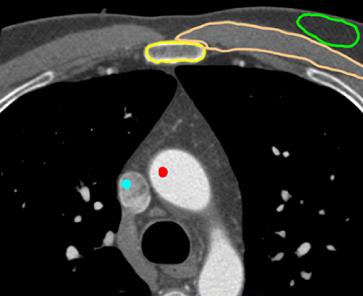 cardiaclabax