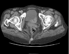 part2case4CT