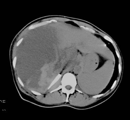 case4pt3CTeffusion1