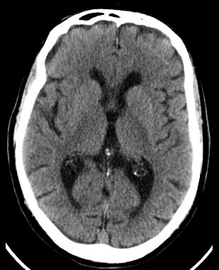 strokeCT