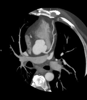 coronaryCTA