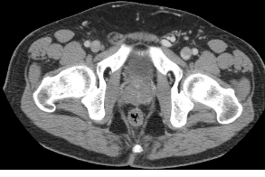 CTvaricocele