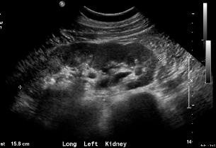 RENALULTRASOUNDnmlLeft