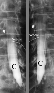 myelogram