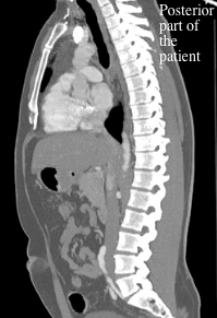 sagittal