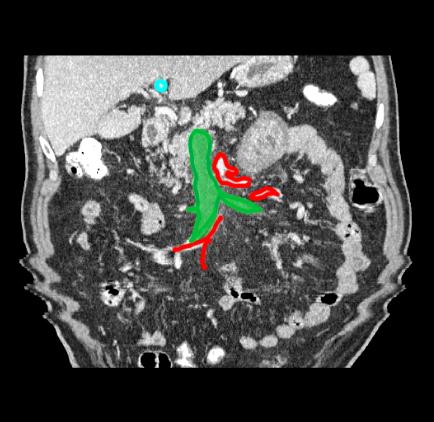 PVthromblabposter