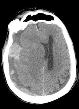 selCTsubdural1