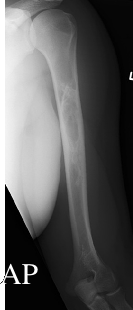 APhumerus