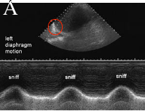 ltdiaphmotion