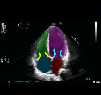 CH25EFConverted50ATRIALSYST