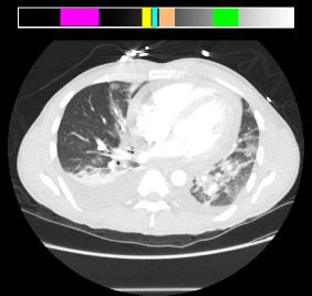 chestLung1