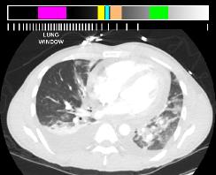 chestLung3